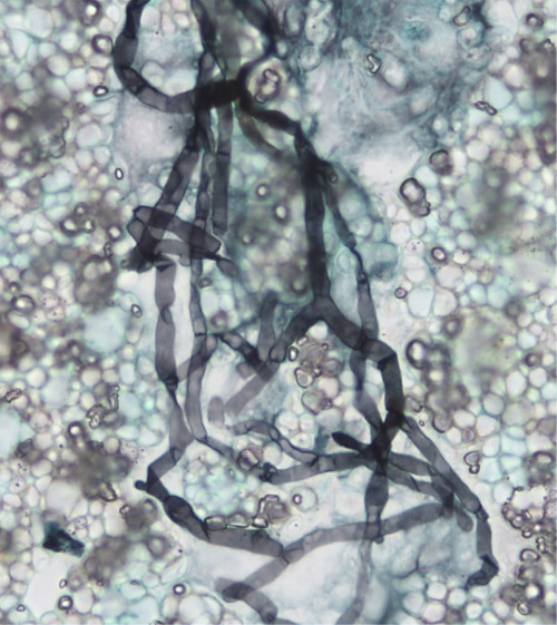 Figure 1. Coloration de Gomori-Grocott d’une cytocentrifugation de lavage bronchoalvéolaire (objectif x100). Les filaments mycéliens produits par H. aspergillata sont septés et ramifiés à angle aigu.